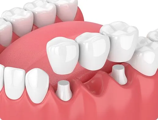 Cách khắc phục tình trạng tiêu xương sau khi mất răng