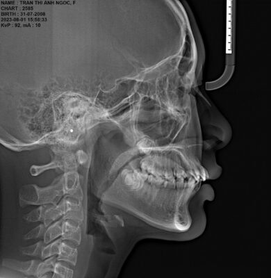 Phim so nghiêng Cefalometric