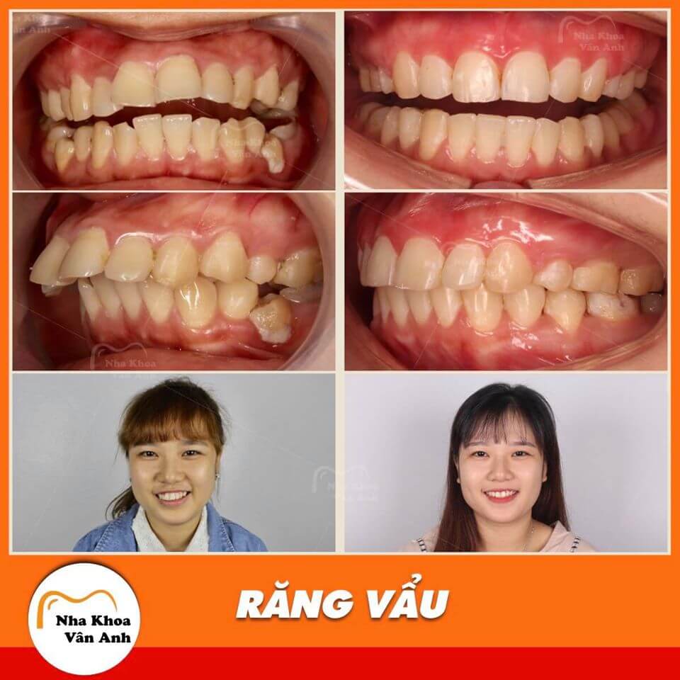Răng vẩu là một trong những trường hợp phổ biến áp dụng niềng răng hiệu quả