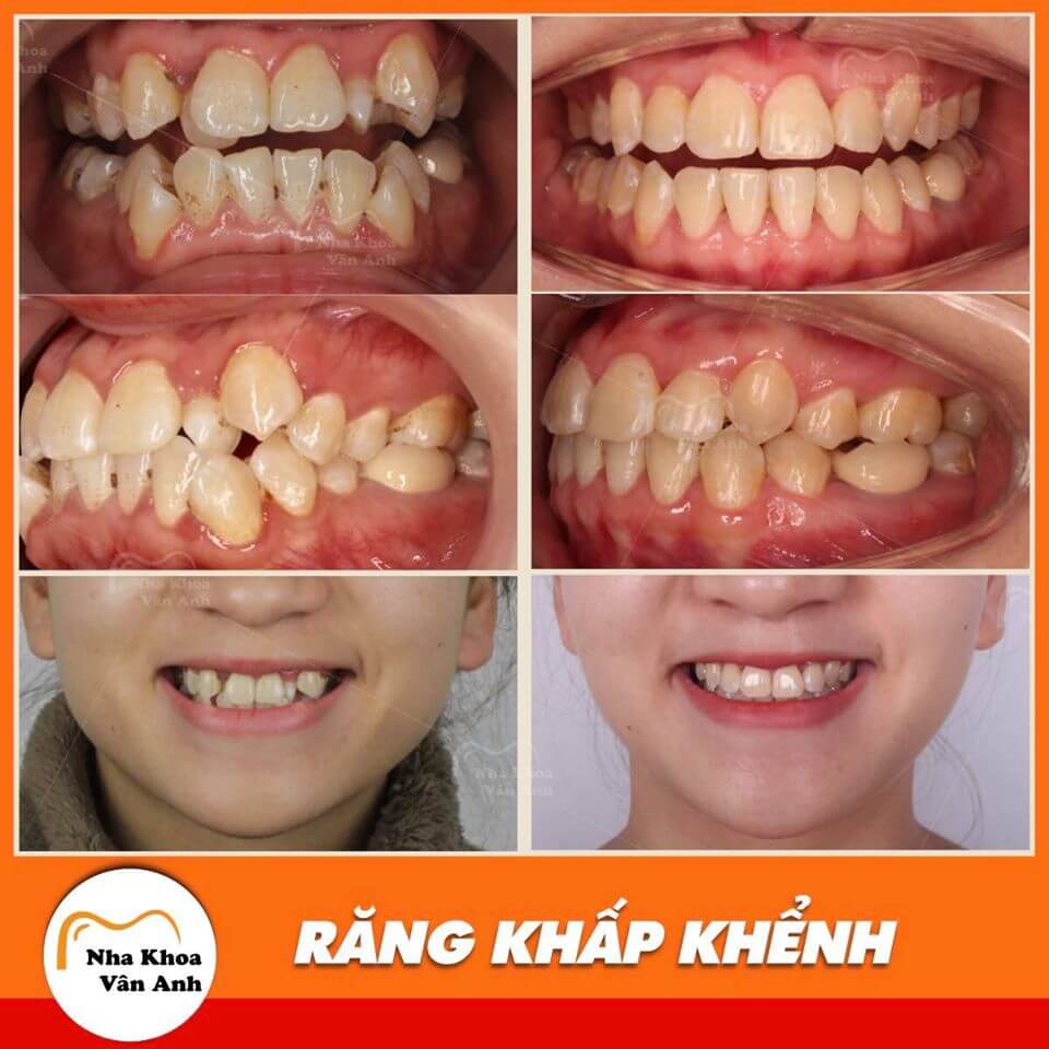 Khách hàng niềng răng thành công tại nha khoa Vân Anh