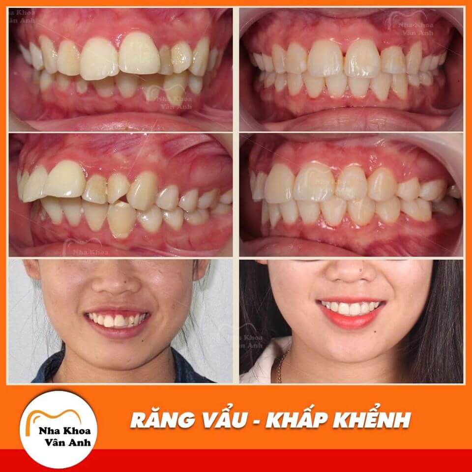 Các trường hợp niềng răng khấp khểnh thành công tại nha khoa vân anh