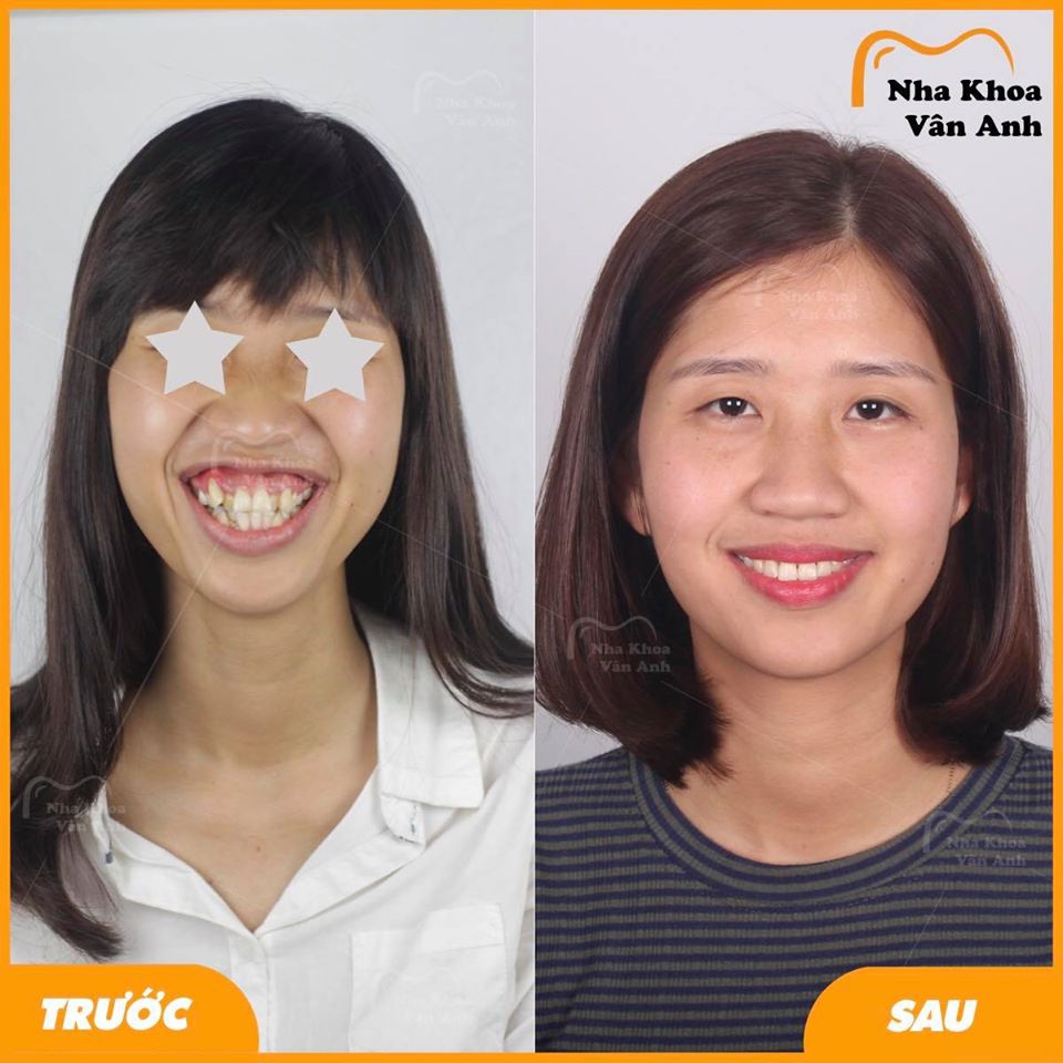 Các trường hợp niềng răng hô thành công tại nha khoa vân anh